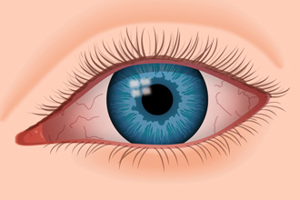 全球唯一治疗干眼症处方药杂质研究——CATO来帮忙